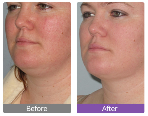 Ultrasonic Cavitation at Home | Before and After (With Photos)